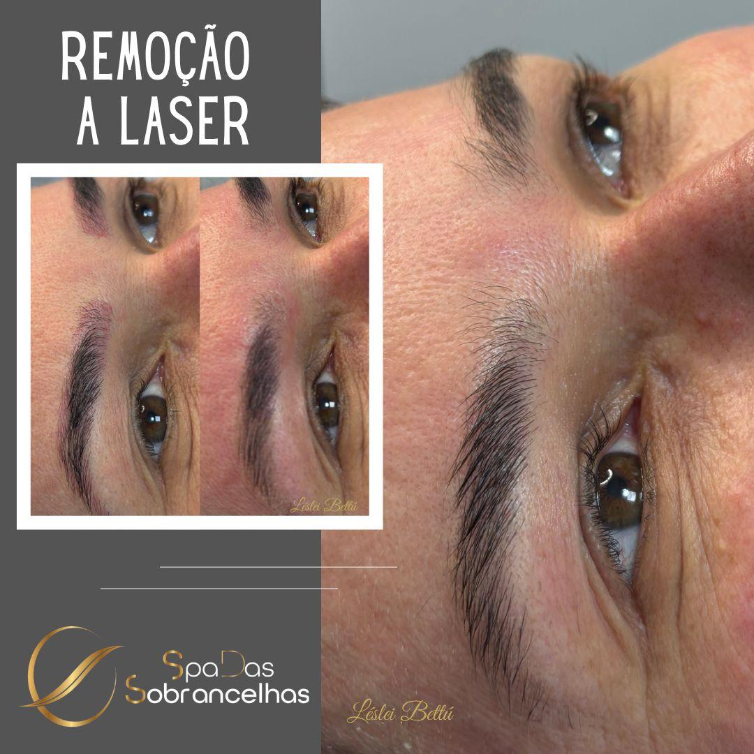Remoção de Micropigmentação